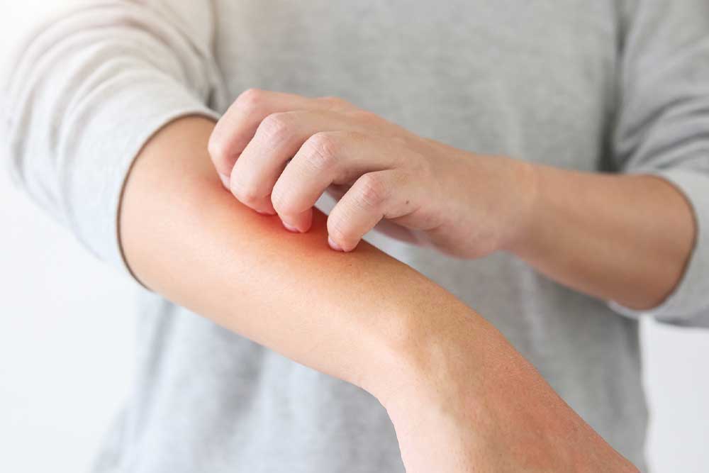 Man scratching arm due to Eczema or Dermatitis