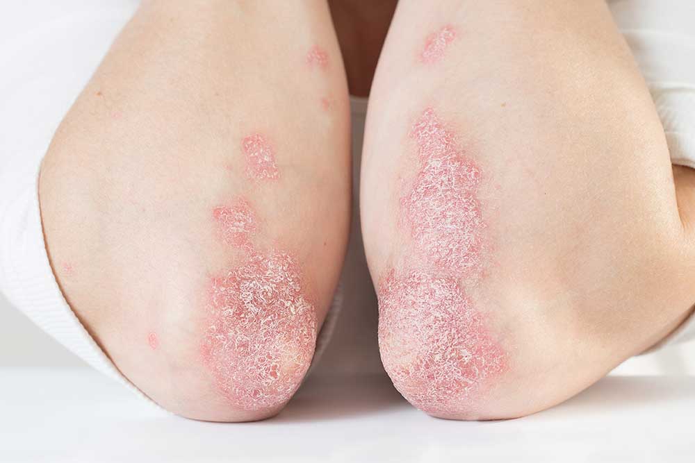 child with Psoriasis on elbows