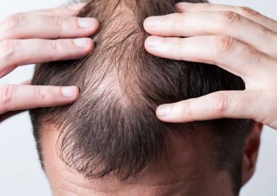Siegel Dermatology | Hair loss and Balding Treatment | Waterford, MI