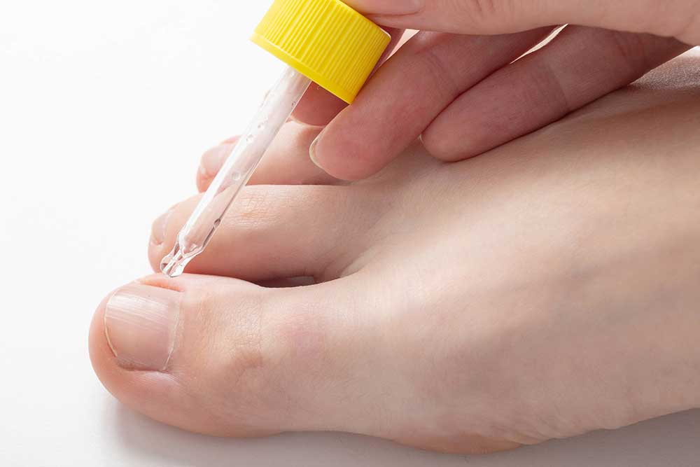 woman treating nail fungus on her big toe
