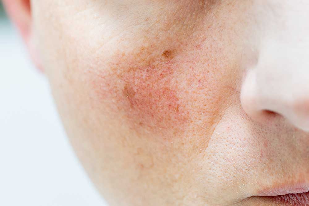 woman with Rosacea on her cheeks